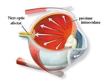 GLAUCOM: SIMPTOME, CAUZE, OPERAȚIE - Laser Vision Med